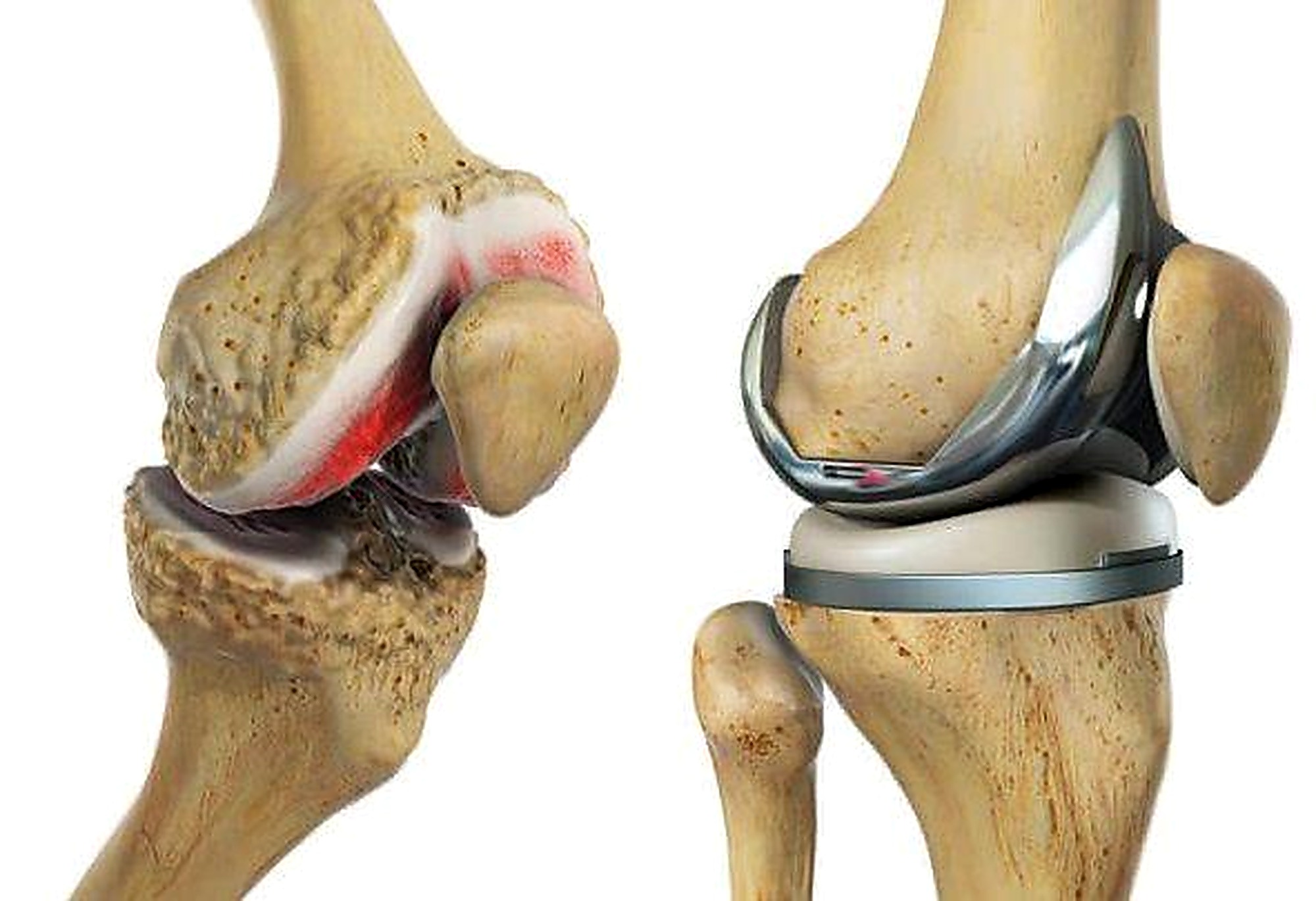 Consultation for revision knee replacement in Surat