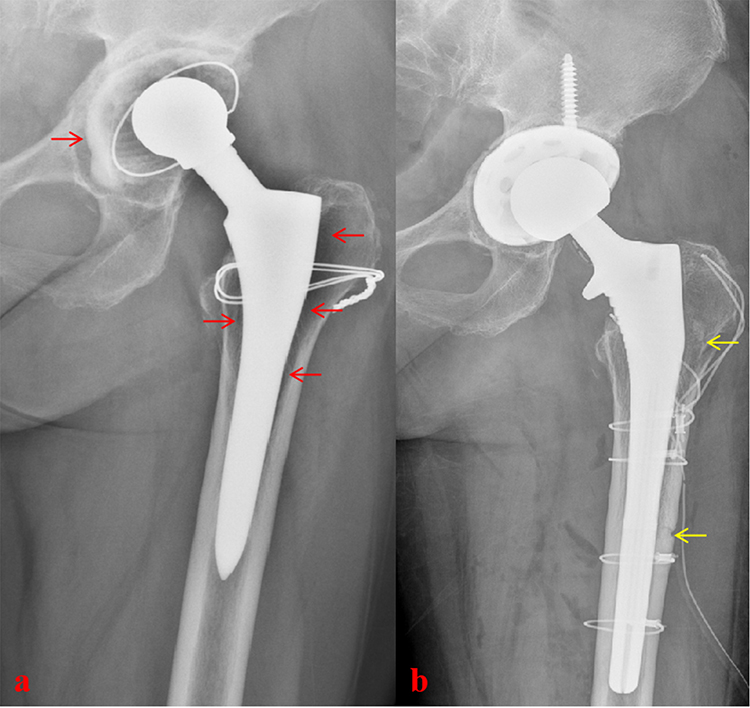 Reasons for revision hip surgery