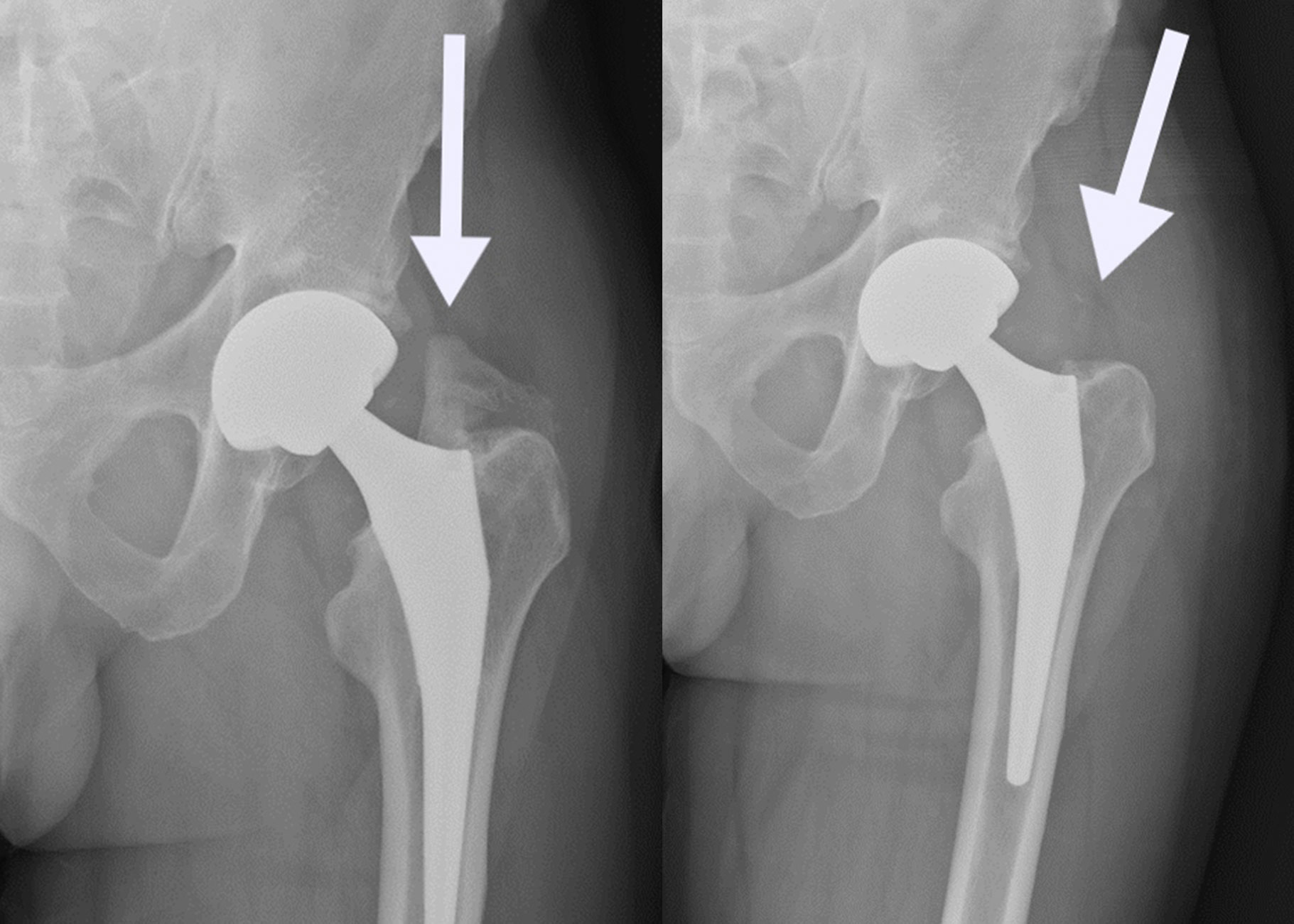 Hip arthroscopy safety