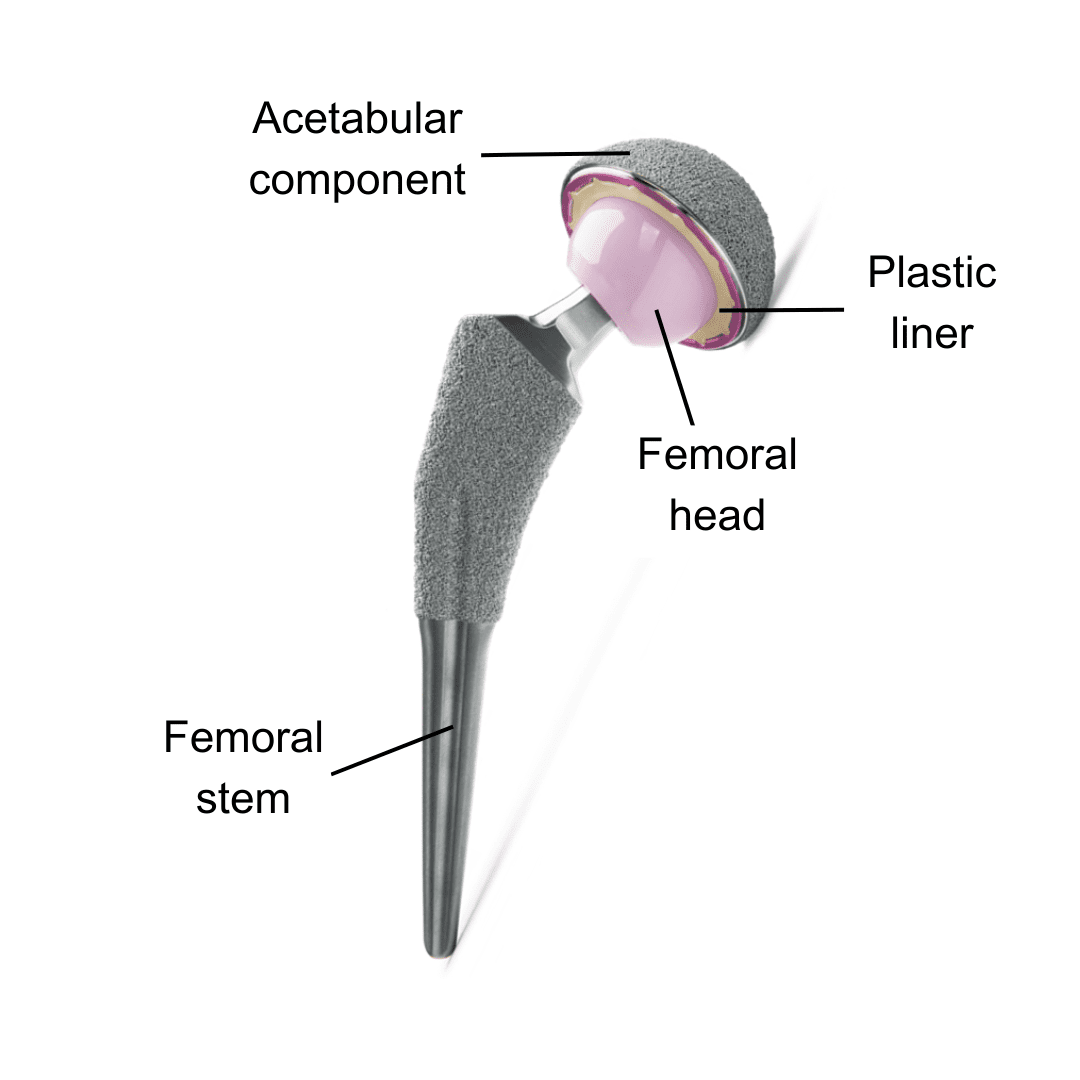 Hip implant components for revision surgery