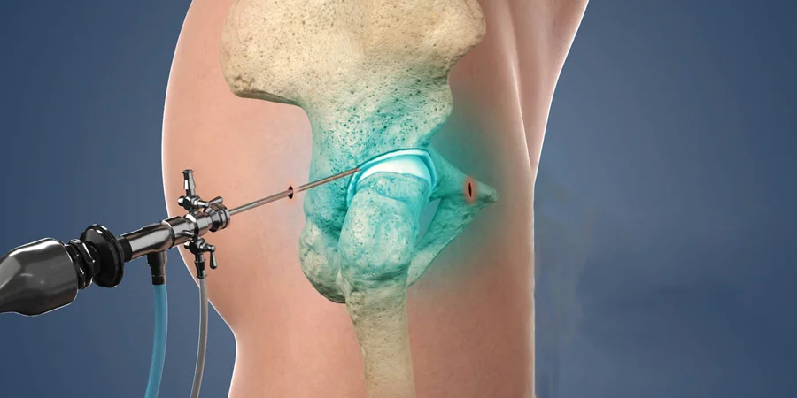 हिप आर्थ्रोस्कोपी प्रक्रिया