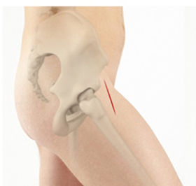 न्यूनतम इनवेसिव हिप रिप्लेसमेंट