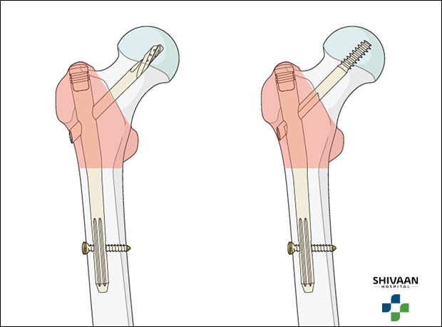 ऑर्थोपेडिक सर्जन हिप फ्रैक्चर एक्स-रे की समीक्षा करते हुए